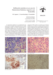 Infiltración medular en un caso de Mastocitosis Sistémica Agresiva con Eosinofilia IMAGEN