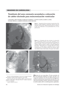 Trombosis del seno coronario secundaria a colocación de catéter
