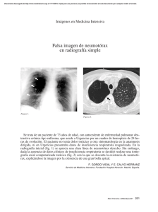 Falsa imagen de neumotórax en radiografía simple
