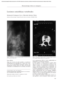 Lesiones osteolíticas vertebrales