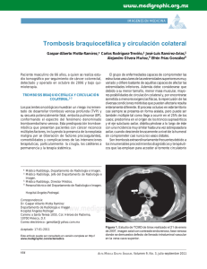 Trombosis braquiocefálica y circulación colateral