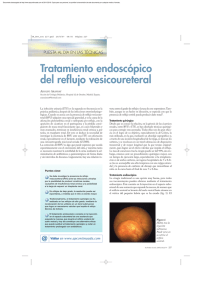 Tratamiento endoscópico del reflujo vesicoureteral
