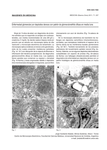 Enfermedad glomerular por depósitos densos con patrón de