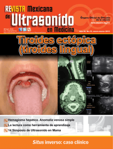 Tiroides ectópica (tiroides lingual) Tiroides ectópica
