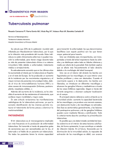 Tuberculosis pulmonar