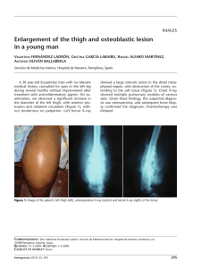 Enlargement of the thigh and osteoblastic lesion in a young man