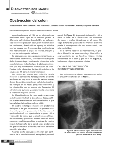 Obstrucción del colon