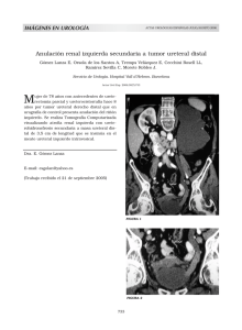 Anulación renal izquierda secundaria a tumor ureteral distal