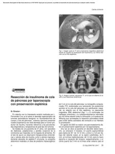 Resección de insulinoma de cola de páncreas por laparoscopia con