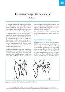Luxación congénita de cadera - Asociación Española de Pediatría