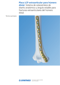 Placa LCP extraarticular para húmero distal. Sistema de