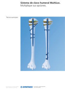 Sistema de clavo humeral MultiLoc. Multiplique sus opciones.