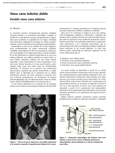Vena cava inferior doble