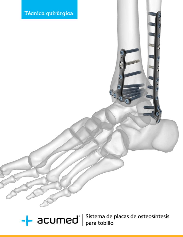 Sistema De Placas De Osteosíntesis Para Tobillo