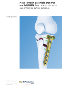 Placa TomoFix para tibia proximal medial (MHT). Para osteotomías