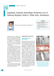 Implante Unitario Inmediato Posterior con el Sistema