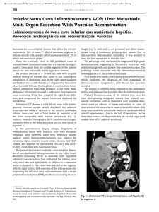 Inferior Vena Cava Leiomyosarcoma With Liver Metastasis