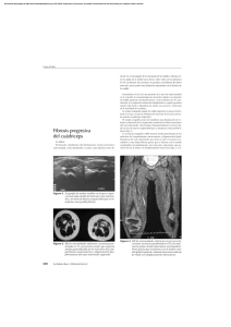 Fibrosis progresiva del cuádriceps