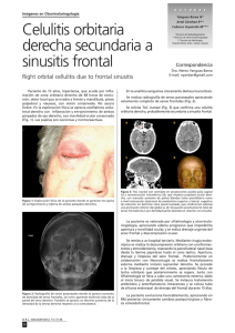 Celulitis orbitaria derecha secundaria a sinusitis frontal