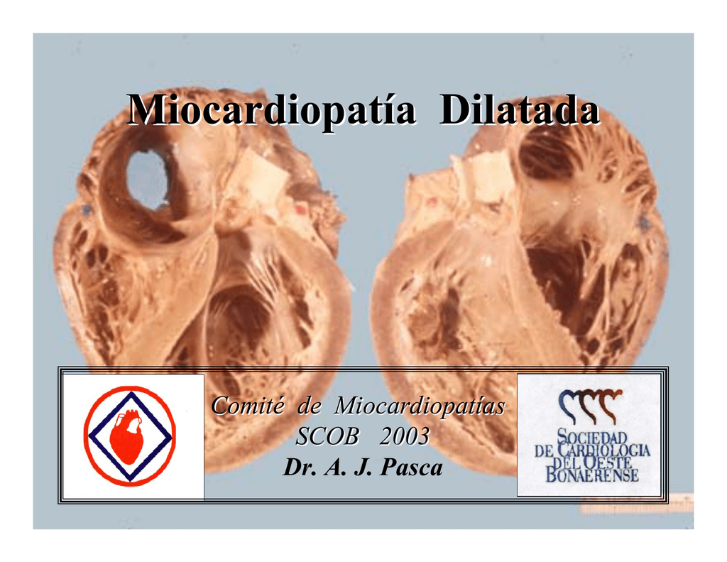 Que Es Miocardiopatía Dilatada Isquemica