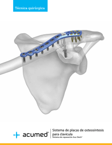Sistema de placas de osteosíntesis para clavícula Técnica