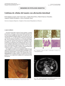 Linfoma de células del manto con afectación intestinal