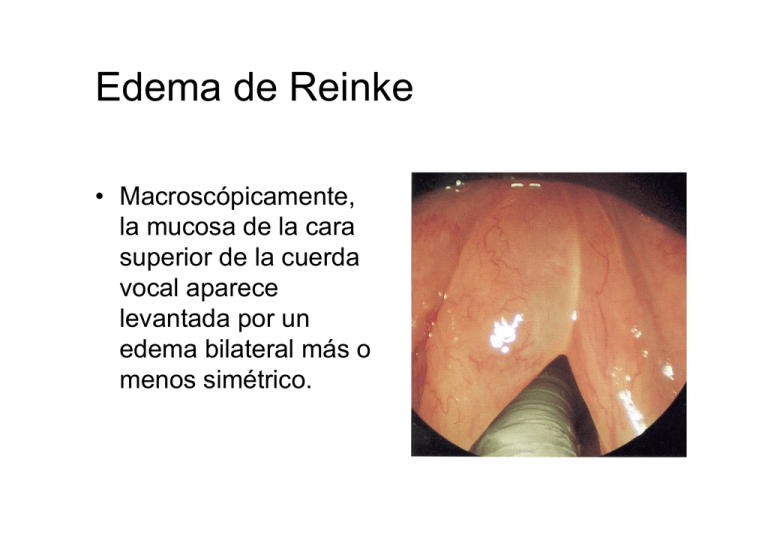 Reinke's Edema Ppt at Marianna Messner blog