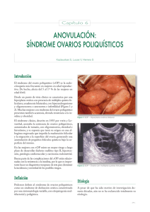 anovulación: síndrome ovarios poliquísticos