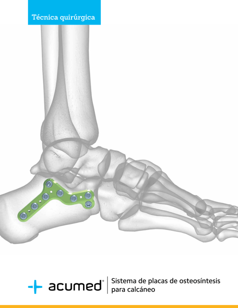 Sistema De Placas De Osteosíntesis Para Calcáneo Técnica Quirúrgica