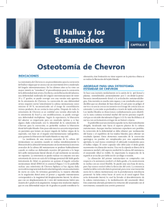 Osteotomía de Chevron El Hallux y los Sesamoideos