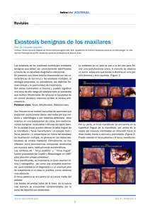Exostosis benignas de los maxilares