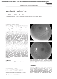Maculopatía en ojo de buey