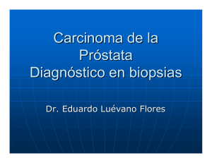 Carcinoma de la próstata Diagnóstico en biopsias