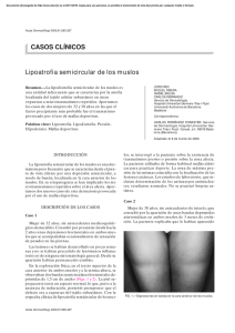 Lipoatrofia semicircular de los muslos CASOS CLÍNICOS