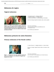 Melanoma de vagina Melanoma primario de uretra femenina