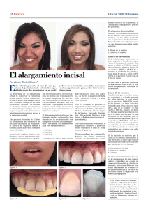 El alargamiento incisal - Dental Tribune International