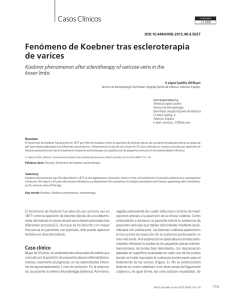 Fenómeno de Koebner tras escleroterapia de varices