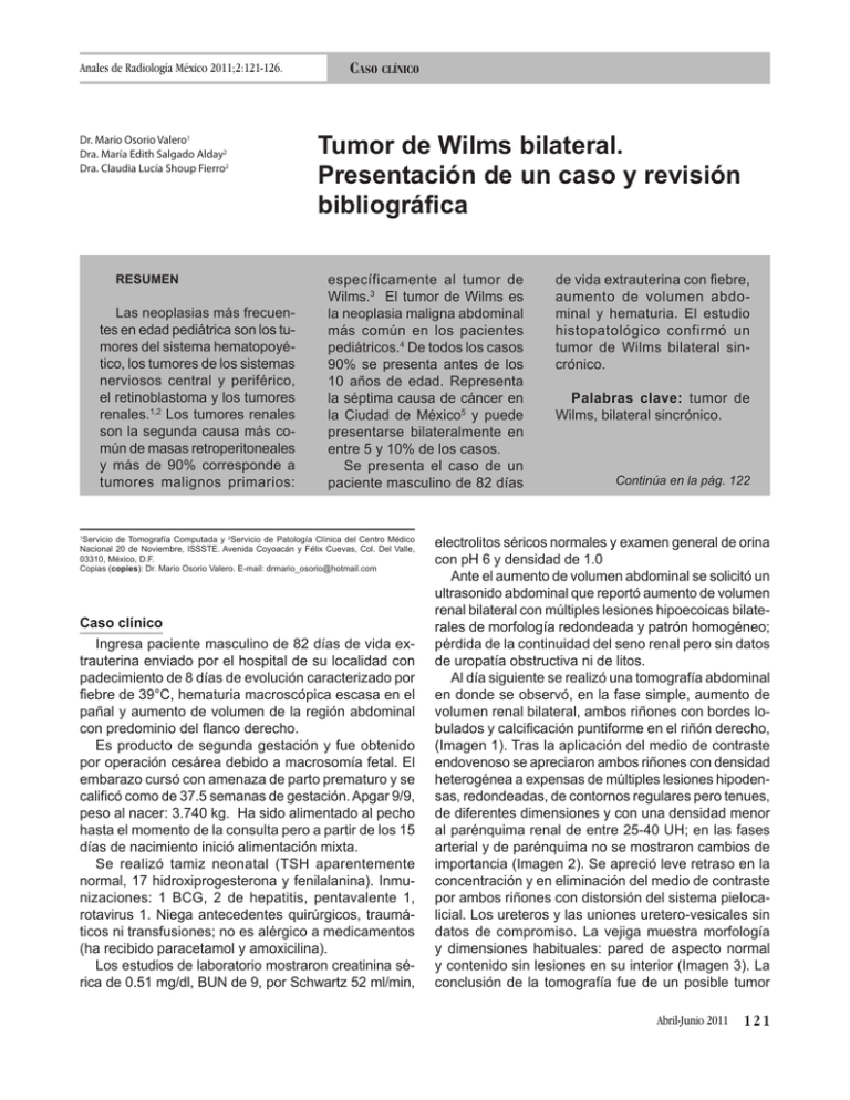 Tumor De Wilms Bilateral Presentación De Un Caso