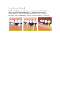 Prótesis fija ( puentes dentales) Tallado de los dientes adyacentes