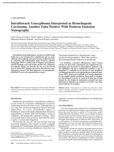 Intrathoracic Gossypiboma Interpreted as Bronchogenic Carcinoma