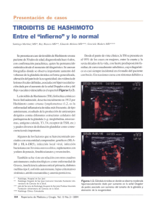 TIROIDITIS DE HASHIMOTO