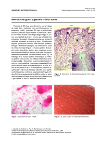Helicobacter pylori y gastritis crónica activa
