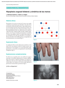 Hipoplasia ungueal bilateral y simétrica de las manos