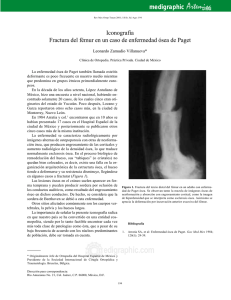 Fractura del fémur en un caso de enfermedad ósea de Paget