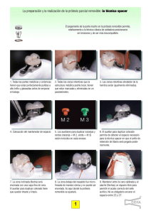 La preparación y la realización de la prótesis parcial removible: la