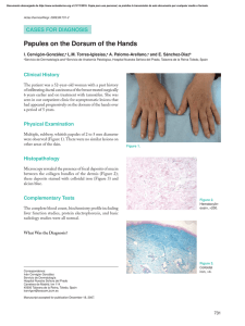 Papules on the Dorsum of the Hands - Actas Dermo
