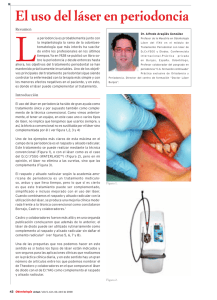 El uso del láser en periodoncia