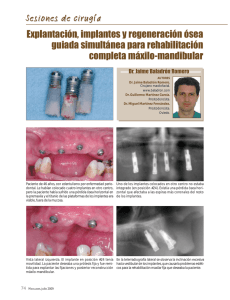 Explantación, implantes y regeneración ósea guiada