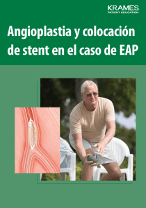 Angioplastia y colocación de stent en el caso de EAP