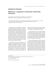 Melanoma y coagulación intravascular diseminada fulminante
